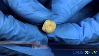 Chairside CEREC Implants and Abutments with James Klim DDS [upl. by Alur628]