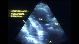 Pericardial effusion or hemopericardium to drahmadmirdamadisi4YcoVxIYKdkLrw2q [upl. by Kant981]