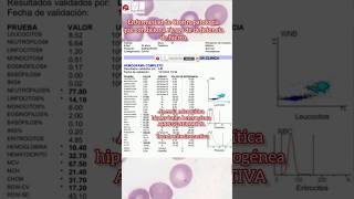 Enfermedad de Crohn y anemia por deficiencia de hierro hematologia medicina [upl. by Porty636]