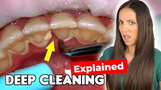 Dental Hygienist Explains Deep Cleaning Procedure [upl. by Nnaira]