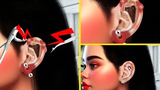 ASMR Infected Ear Piercing Treatment Animation  ASMR Ear Pus Removal Animation  ASMR Derm [upl. by Eelyahs]