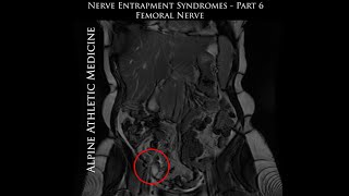 Femoral Nerve Entrapment ImageGuided MinimallyInvasive Treatment of Peripheral Femoral Nerve [upl. by Enelegna625]