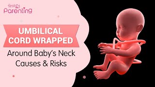 Umbilical Cord Around Babys Neck Nuchal Cord  Causes Risks and Prevention [upl. by Nairad45]