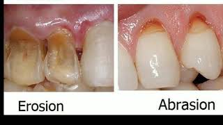 Non carious cervical lesions  erosion abrasion and abfraction [upl. by Eidak975]