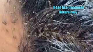 Head lice treatment in natural wayremove head lice in a single daykuto removalhome remedy lice [upl. by Karr]