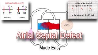 Atrial Septal Defect ASD Pathophysiology amp Clinical Features [upl. by Mirella]