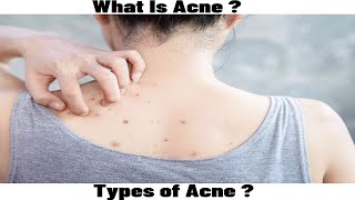 What Is Acne Types Of Acne [upl. by Ener674]