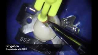 Manual Technique for Curved Root Canal Preparation [upl. by Nanam]