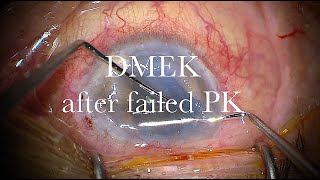 DMEK after failed PK in a vitrectomized eye [upl. by Hussein]