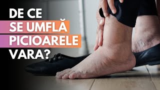 De ce se umflă picioarele vara Sfaturi de la Dr Cristina Neagu [upl. by Grantham192]