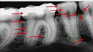 Radiographie rétro  alvéolaire [upl. by Bunting341]