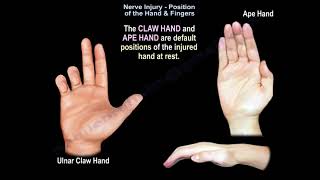 Nerve Injury Position of the Hand amp Fingers  Everything You Need To Know  Dr Nabil Ebraheim [upl. by Wallach228]