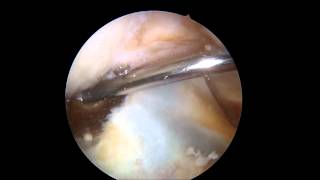 RODILLA ArtroscopiaCuerpo Libre Intraarticular  Dr Gonzalo Mora [upl. by Raleigh]