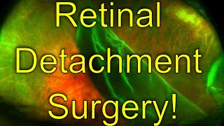 Retinal Detachment Surgery  Giant retinal tear repair  vitrectomy surgery  Dr Simon Chen [upl. by Douty178]