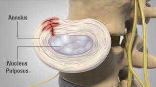 Patient Animation  Lumbar Degenerative Disc Disease [upl. by Salohci]