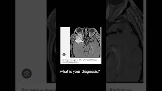 meningiomawhat u should check [upl. by Amabelle]