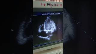 2D ECHO  EF 38  LV GLOBAL HYPOKINESIA DILATED LV LA RA [upl. by Merp]