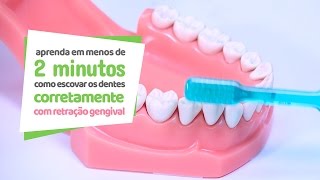 Como escovar os dentes com retração gengival  Cir Hospital Odontológico [upl. by Agretha]