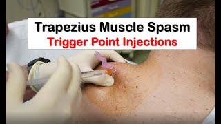 Trapezius Muscle Spasm Trigger Point Injection [upl. by Ardeahp]