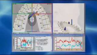 Clinical Adjustment with the TScan™ System [upl. by Fredella]