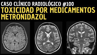 Caso clínico 100 Toxicidad por medicamentos Metronidazol [upl. by Winterbottom]