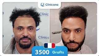 Résultat de greffe de cheveux Clinicana cheveux frisé type afro [upl. by Leruj]