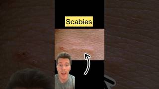 Doctor explains SCABIES in 60 seconds  causes symptoms treatment shorts scabies health [upl. by Nwahsel]