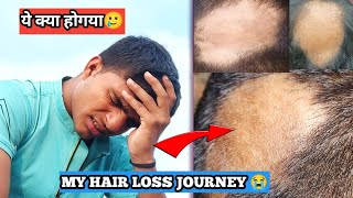 My Hair Loss Journey😭  suffer with alopecia areata since 1 year  Painful story🥲 Fit Rishu [upl. by Yanffit]