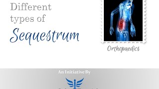 Types of Sequestrum in less than 3 mins [upl. by Allwein50]