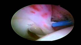 Labral Tear  Detached Anterior Labrum [upl. by Eiuqram]