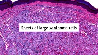 Pathology of Tendinous Xanthoma by Dr Sampurna Roy MD [upl. by Hanala]