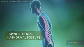 Ankylosing Spondylitis Symptoms [upl. by Sarah]