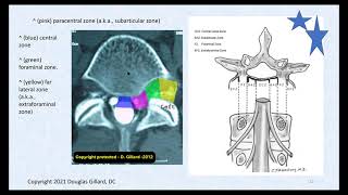 3 Key Ligaments of the Lumbar Spine and Their Related Pathology Disc Herniation Stenosis amp DISH [upl. by Ha]