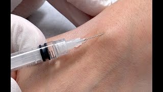 Petra Ganglion Wrist Cyst Aspiration [upl. by Naivat]