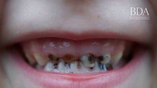 Child tooth decay in Northern Ireland [upl. by Cherish]