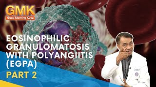 Eosinophilic Granulomatosis with Polyangiitis EGPA Part 2  Usapang Pangkalusugan [upl. by Ariam]