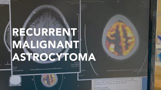 Malignant AstrocytomaGlioblastoma [upl. by Wylie135]