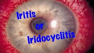 Medical Video Lecture Ophthalmology Iridocyclitis or Iritis Made simple [upl. by Forta725]