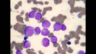 Acute Myeloblastic Leukemia M1 [upl. by Ratib]