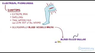 Clostridium Perfringens  Osmosis [upl. by Yole]