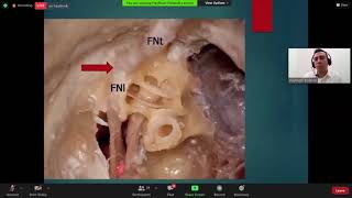 Facial Nerve Surgical Anatomy [upl. by Atteoj]