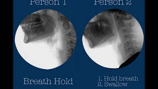 Swallowing postures and maneuvers with videofluoroscopy two healthy adults [upl. by Krug]