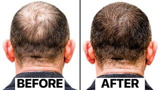 The Truth Behind This New Hair Loss Treatment  Exosomes [upl. by Ettereve696]