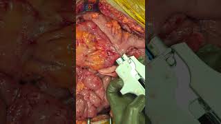 Stage 3 Colon Cancer How We Treat It with Surgery amp Chemotherapy  Dr Praveen Kammar Mumbai [upl. by Namyac]