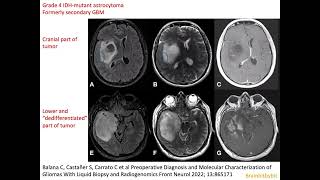 62 Glioblastoma versus astrocytoma IDHmutant grade 4 GBM prognosis different TME immunotherapy [upl. by Duahsar]