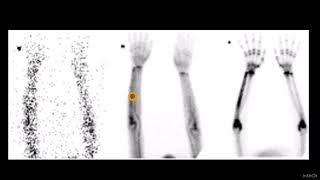 tkr 04 CELLULITIS SOFT TISSUE SARCOMA AND OSTEOMYELITIS ON 3 PHASE BONE SCAN🚦 [upl. by Lleuqram]