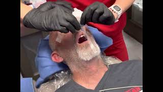 CRNA Anesthesia Nasal Intubation POV Dental Office [upl. by Shelly300]