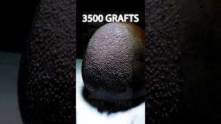 NORWOOD SCALE  GRAFTS NUMBER  HAIR LOSS LEVEL [upl. by Padriac856]