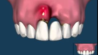 Implant dentar sau punte dentara [upl. by Cacka]