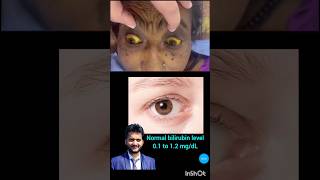 jaundice पीलिया icterus bilirubin liver disease health shorts nursing [upl. by Ateekal906]